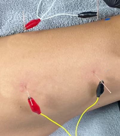 Elletroagopuntura - terapia del dolore a Sirmione - Dr. Mihaela Petrican
